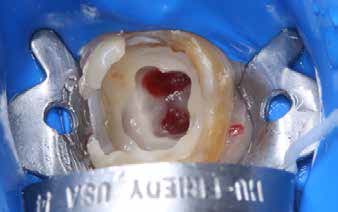 . Occlusal view of the pulpotomy.