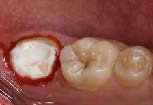 . Preparation performed on the mandibular second
molar.