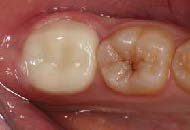 . Photograph of the crown 1 week after cementation.
The crown appears clean, the gingival tissue is
healthy, and tooth sensitivity has disappeared.