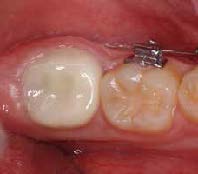 . Follow-up at 40 months after crown placement. The
tooth is asymptomatic and the gingival tissue appears
healthy.