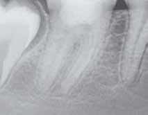 . Periapical control x-ray 40 months post-op.