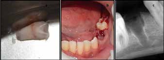 a. Avulsed mandibular left second premolar (35) with
incomplete root development b. Clinically missing
premolar c. Alveolar socket after avulsion.