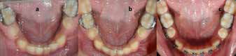 Clinical images showing continued eruption
of mandibular left second premolar (35) (a-c).
Radiographic images showing completed root
development and normal periodontal ligament space
(d-f).