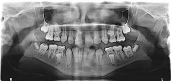 Preoperative Orthopantomogram showing primary
mandibular left and right second molars encircling the
crowns of their succedaneous premolars.
