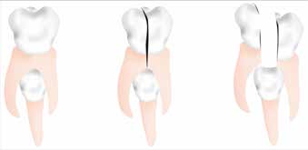 Illustration showing the sectioning of crown of
the primary mandibular second molar followed by
extraction in segments.