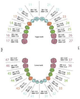 Frequency of Dental Fluorosis (DF) and Molar-Incisor
Hypomineralization (MIH) involvement per tooth.
