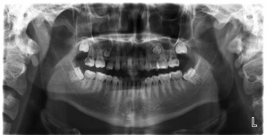 . Panoramic radiograph showing missing upper right premolar bud (NovemPanoramic radiograph showing upper second premolars were in Nolla’s stage 6 (July 2018)
