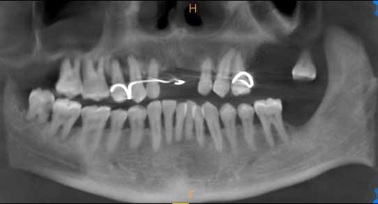 . Cone-beam computed tomography section showing missing teeth in his father (March 2017)