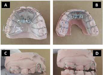 Sander bite jumping appliance; A, Maxillary plate; B,
Mandibular plate; C, Lateral view of the elements long
16 mm; D, Lateral view showing how the two plates
interconnect with each other determining a mandibular
advancement