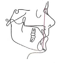 Effects of Orthodontic Functional Appliances in Relation to Skeletal
Maturation of Cervical Vertebrae In Class II Malocclusion figure 4