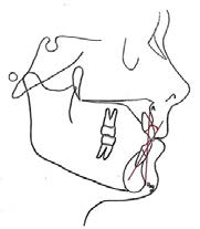 Effects of Orthodontic Functional Appliances in Relation to Skeletal
Maturation of Cervical Vertebrae In Class II Malocclusion figure 6