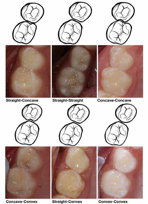 Journal of Clinical Pediatric Dentistry (JOCPD)