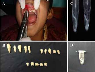 . A. Extraction of primary anterior tooth under local anesthesia (2% lignocaine and
1:80,000 adrenaline). B. Tooth samples collected with varying levels of root
resorption (from top left: 0 to 1/3rd root resorption; 1/3rd to 2/3rd root resorption;
and bottom row, 2/3rd to complete root resorption). C & D. Pulp extirpated from
tooth samples for the isolation of stem cells from human exfoliated deciduous
teeth (SHED).