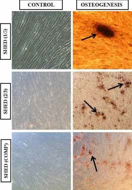 . Osteogenic differentiation of SHED. Cells cultured in
basal medium showed fibroblast-like morphology.
Mineralization of calcium nodules was exhibited by
differentiated osteocytes from SHED as assessed by
Alizarin red-S staining (arrows). (Images: ×20).