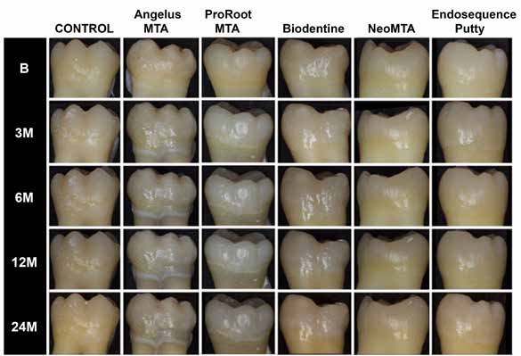 . Time-dependent changes in tooth color as viewed on digital photographs. B=Baseline.