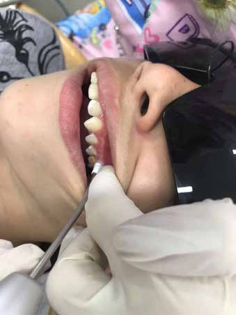 . Low-level laser therapy (LLLT) was applied
perpendicularly to the cervical region of the
permanent maxillary left first molar affected by molar
incisor hypomineralization (MIH).