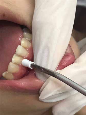 . Use of low-level laser therapy (LLLT) to control
hypersensitivity on permanent mandibular incisors.