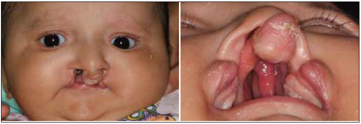 . Facial and intraoral views of the infant presenting with bilateral cleft lip and palate.