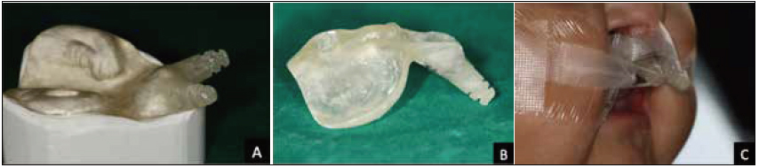 . A, The alveolar molding plate made in self-cure acrylic; B, retentive arms angulated at 45°; C, lip taping and elastic traction.