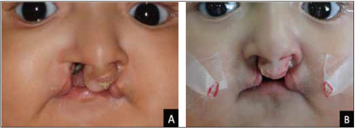 . A, Preatment premaxillary position; B, premaxillary derotation and centering completed at end of stage 1.