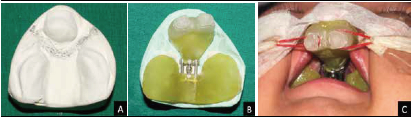 . A, The working model prepared for sectioning; B, the expansion screw appliance adapted and relined to
the end of state 1 dimensions; C, the appliance fitted intraorally to begin premaxillary retraction.