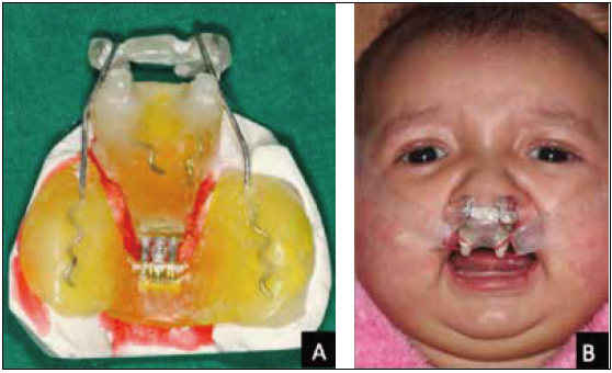 . A, The modified appliance with nasal stents supported from the posterior segment; B, appliance in
position with swan neck shaped nasal stents positioned mesially in the nostrils.