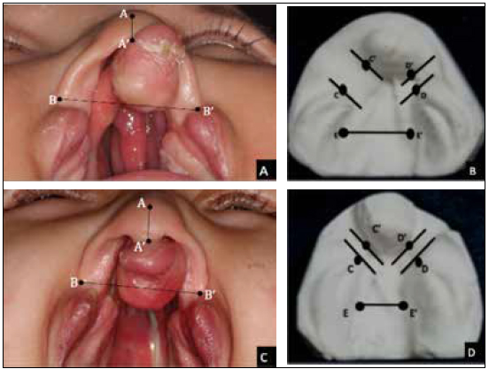 . Pre- and posttreatment records were evaluated for changes with
respect to cleft reduction and symmetry achieved. A, pretreatment
facial landmark measurement (AA’: columella length, BB’: nasal
width); B, pretreatment model landmark measurement (CC’, DD’:
intersegment distances for right and left sides respectively, EE’:
cleft width); C, posttreatment facial landmark measurement;
D, posttreatment model landmark measurement.