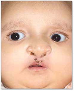 . Postoperative facial photograph taken
one week after lip closure surgery.