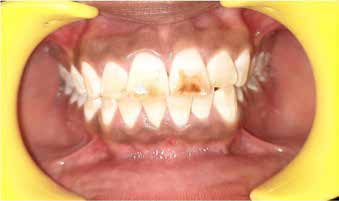 : Pretreatment picture showing unaesthetic appearance
of maxillary incisors (Group I)