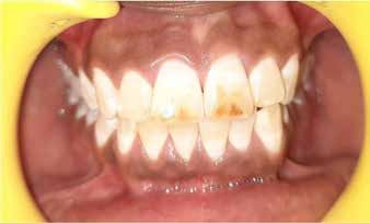 : Post treatment picture after in-office bleaching with 30%
H2O2 was performed (Group I)