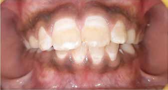 : Pretreatment picture showing unaesthetic appearance
of maxillary incisors (Group II)