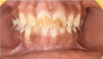 : Pretreatment picture showing unaesthetic appearance
of maxillary incisors (Group III)