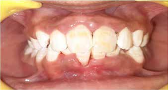 : Post treatment picture after enamel microabrasion
technique was performed (Group IV)