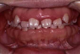 . Intraoral presentation after dental plaque staining at the first visit (March 2003, plaque control record: 34%,
bleeding on probing: 5.4%). Interdental separation
and odontoparallaxis were observed, but there was no
tooth mobility.