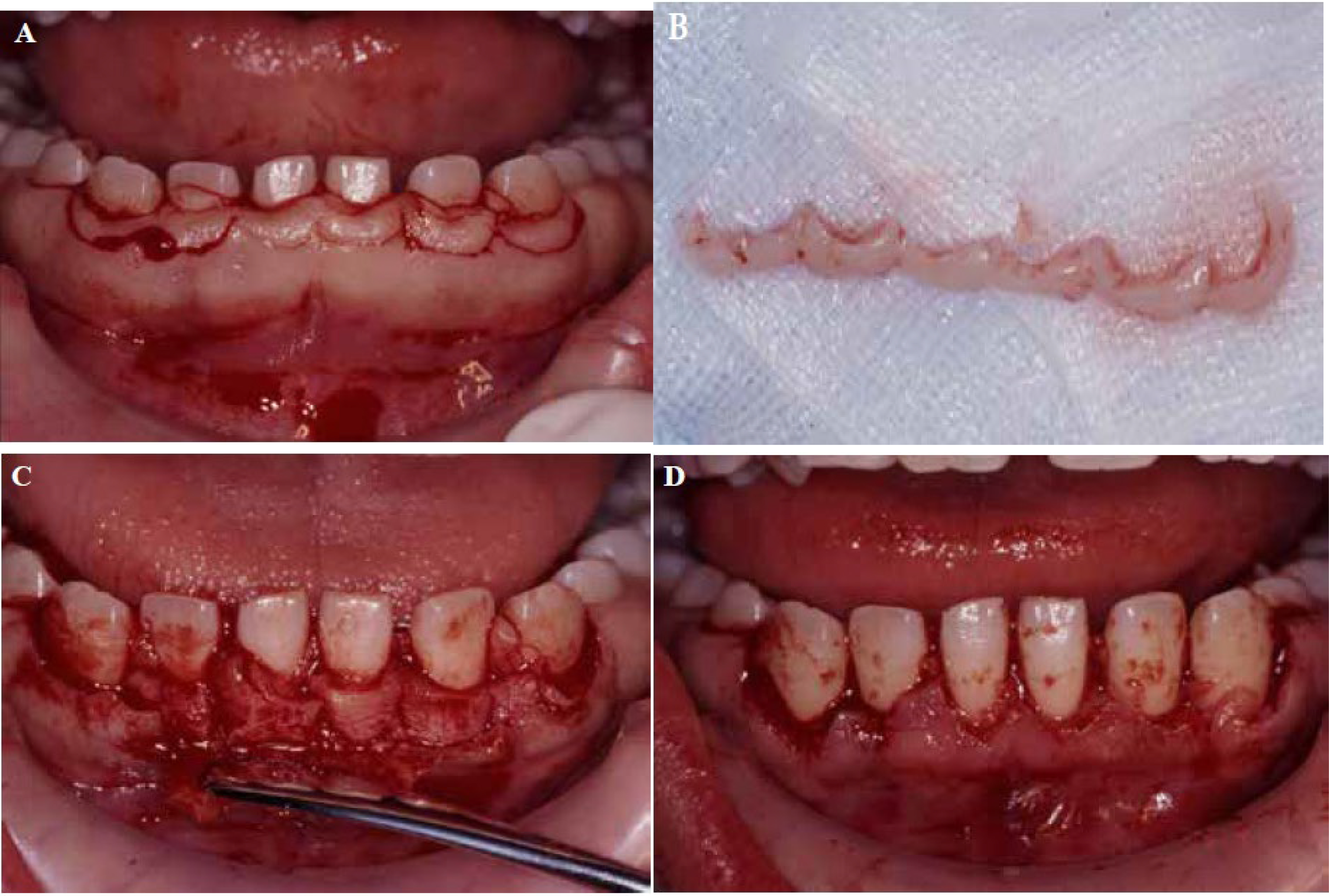 . Inverse bevel flap procedure (#33–#43). A primary
incision was made along the cemento-enamel junction
(a). Excess gingiva was removed vertically (b). A
tightly bound thick connective tissue layer remained
(c). The flap was repositioned with the connective
tissue removed (d).