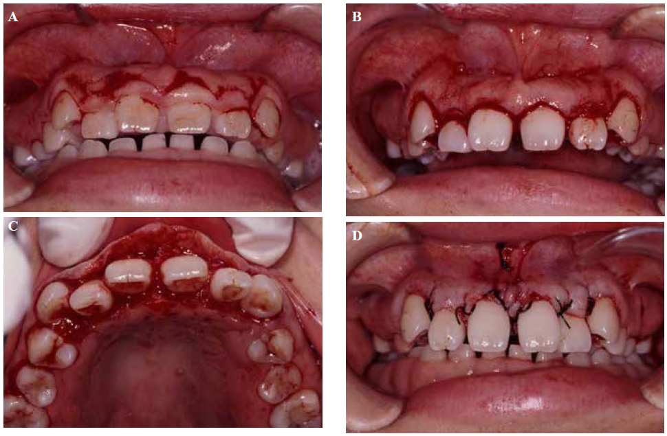 . Inverse bevel flap procedure (#13–#23) showing the primary incision (a). After the removal of excess gingiva (b). This
procedure aims to reduce the thickness of connective tissue (c). View after suturing (d).