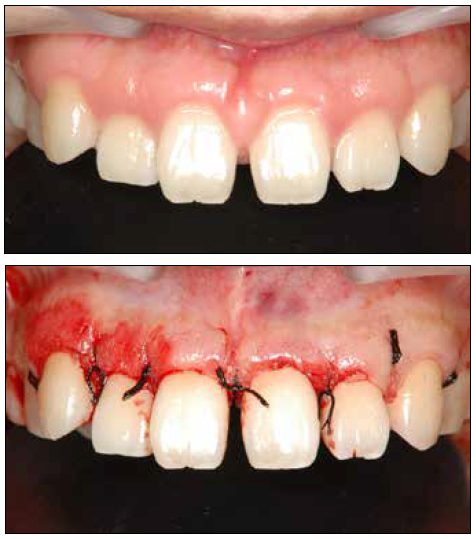 . Gingival regrowth after the complete gingivectomy. An
additional gingivectomy was performed.