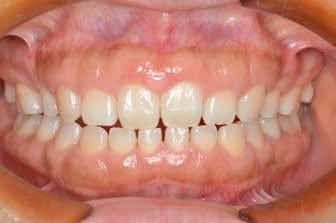 . At 15 years postoperatively (aged 38 years). No
gingival regrowth was observed and healthy
periodontal tissue was maintained.