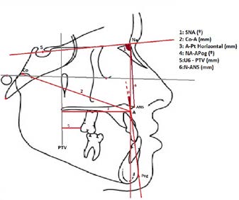 1- Cephalometric measurements: SNA (º), Co-A (Medium
face length) (mm), A-PTV Horizontal (mm), Na-APog
(Convexity) (º), U6-PTV Vertical (mm), Na-ANS (Upper
face height) (mm)
SNA (º): the angle indicating the position of the maxilla in the
sagittal direction relative to the anterior cranial base. Co-A
(Medium face length) (mm): the distance between the condyle
and point A that specifies the middle face length. A-PTV
Horizontal (mm): the distance from point A to PTV. Na-APog
(Convexity) (º): the angular value of skeletal convexity. U6-PTV
Vertical (mm): the distance from the upper 1st molar to the PTV.
Na-ANS (Upper face height) (mm): the distance between the
Anterior Nasal Spina that specifies the upper face height.