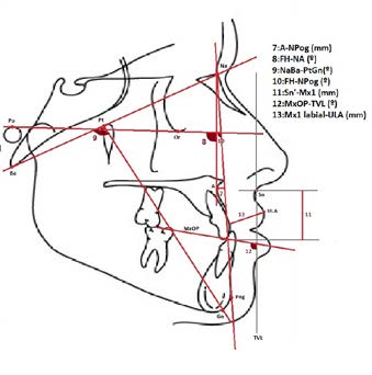 - Cephalometric measurements: A-Na-Pog (Convexity)
(mm), FH-Na-A (Maxillary depth) (º), NaBa-PTV-Gn
(Facial Axis-Ricketts) (º), FH-NPog (Facial angle) (º),
Sn’-Mx1 (Front maxillary height) (mm), MxOP-TVL
(Maxillary occlusal plane) (º), Mx1 labial-ULA (Upper lip
thickness) (mm).