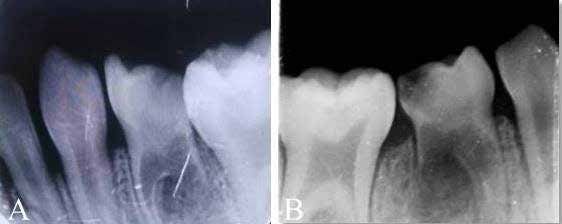 : Pre-operative intraoral periapical radiographs of mandibular right first primary molar (A) and
mandibular left first primary molar (B)