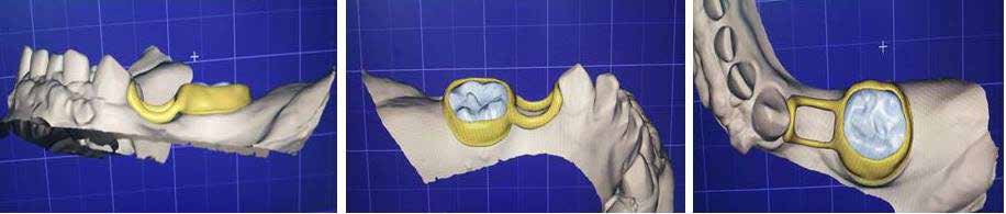: Designing of 3D printed band and loop space maintainer using 3D digital dental scanner