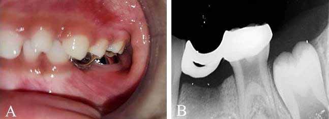 : Post-operative intra oral clinical (A) and periapical radiograph (B) of 3D printed band and loop space
maintainer cemented on mandibular left first primary molar.