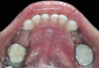 : Post operative intra oral photograph