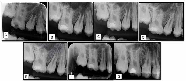 : Group A (Biodentine)Preoperative (A) and postoperative follow up radiographs (B- 3 weeks, C- 3 months,
D- 6 months, E- 12months, F- 18 months, G- 24 months)