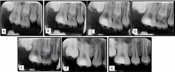 : Group B (Theracal LC) Preoperative (A) and postoperative follow up radiographs (B- 3 weeks, C- 3
months, D- 6 months, E- 12months, F- 18 months, G- 24 months)