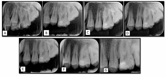 : Group C Dycal) Preoperative (A) and postoperative follow up radiographs (B- 3 weeks, C- 3 months, D- 6
months, E- 12months, F- 18 months, G- 24 months)