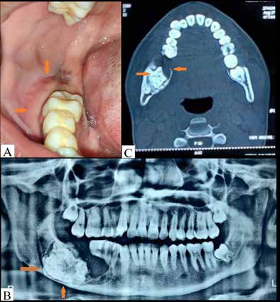 . Clinical and radiographic findings:
A. A bony hard swelling in the right mandibular posterior region encircling
#46 and extending to retromolar region.
B. Orthopantomogram (OPG) revealed a well-defined multilocular
radiolucency surrounding the radio opaque mass with respect to
44, 45 and 46. Resorption of roots of 45 and 46 also observed.
C. Axial view of computed tomography (CT) showed multilocular
radiolucency in posterior mandible with breach in cortical plates
associated with radiopaque mass.