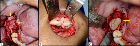 . Surgical findings: A. Bony defect after excision of lesion.
B. Transosseous wiring after excision for stabilization of iatrogenic fracture of lower
border of mandible.
C. Placement of Amalgamated Platelet Rich Fibrin (PRF) and Demineralized freeze-dried
bone allogenic graft (DFDBA).