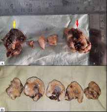 . Macroscopic findings: A. A
hard-calcified mass (red arrow)
and one soft tissue bit (yellow
arrow) along with #45 and 46.
B. Cut sections of hard tissue showed
periphery of bony hard tissue
containing soft tissue within it.